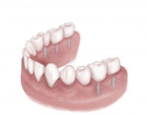 Drawing Showing Multiple Missing Teeth Fixed