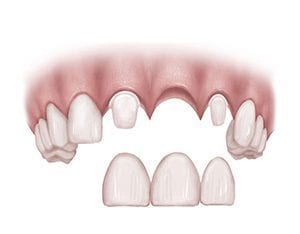 Drawing Showing Adjacent Teeth Cut Down For Bridge Placement