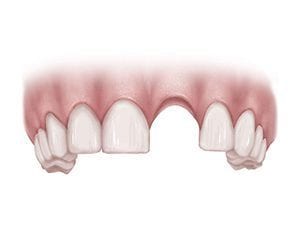 Drawing of Single Missing Tooth