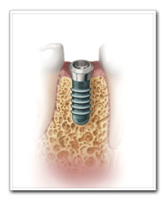Drawing of Implant Placement Copy Drawing of Implant Placement Copy