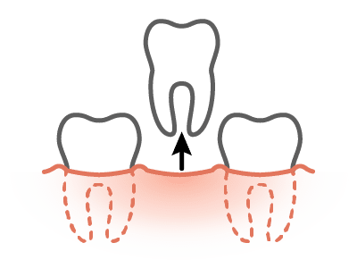 Figure of a tooth extraction
