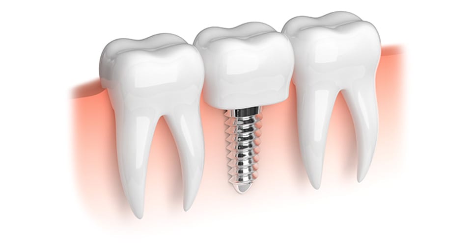 Diagram of a dental implant