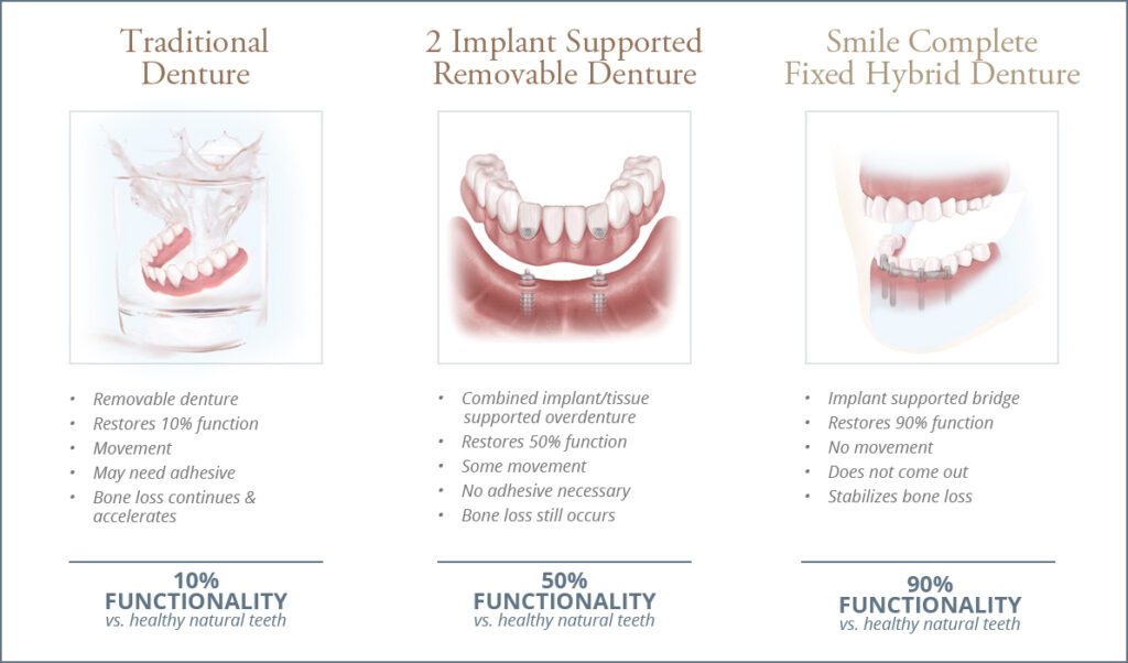 Drawings of traditional dentures 2 implant supported removable denture and smile complete fixed hybrid denture 